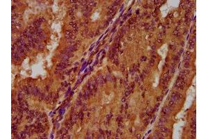 IHC image of ABIN7162774 diluted at 1:300 and staining in paraffin-embedded human endometrial cancer performed on a Leica BondTM system. (PGLYRP1 Antikörper  (AA 22-196))