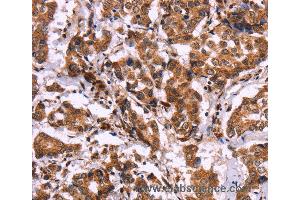 Immunohistochemistry of Human liver cancer using CARD11 Polyclonal Antibody at dilution of 1:40 (CARD11 Antikörper)