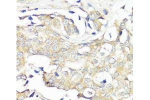 Immunohistochemistry of paraffin-embedded Human breast cancer using EIF3B Polyclonal Antibody at dilution of 1:100 (40x lens). (EIF3B Antikörper)