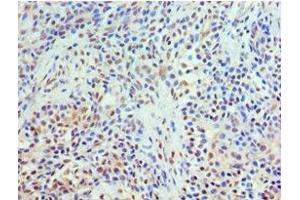 Immunohistochemistry of paraffin-embedded human breast cancer using ABIN7172022 at dilution of 1:100 (TXNRD2 Antikörper  (AA 100-310))