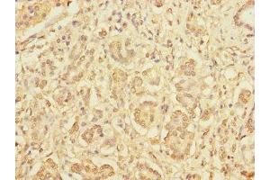 Immunohistochemistry of paraffin-embedded human pancreatic cancer using ABIN7165266 at dilution of 1:100 (DIAPH2 Antikörper  (AA 1-120))