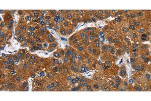 Immunohistochemistry of paraffin-embedded Human liver cancer tissue using CATSPER3 Polyclonal Antibody at dilution 1:60 (CATSPER3 Antikörper)