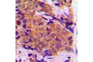 Immunohistochemical analysis of EIF4E staining in human breast cancer formalin fixed paraffin embedded tissue section. (EIF4E Antikörper  (C-Term))