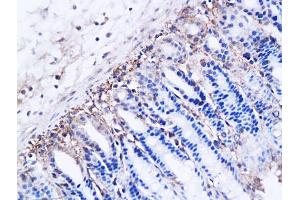 Formalin-fixed and paraffin embedded human breast carcinoma labeled with Anti DBC2 Polyclonal Antibody, Unconjugated (ABIN706241) at 1:200 followed by conjugation to the secondary antibody and DAB staining (RHOBTB2 Antikörper  (AA 631-727))