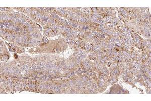 ABIN6267191 at 1/100 staining Human thyroid cancer tissue by IHC-P.