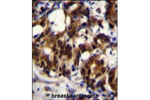TRADD Antibody immunohistochemistry analysis in formalin fixed and paraffin embedded human breast carcinoma followed by peroxidase conjugation of the secondary antibody and DAB staining. (TRADD Antikörper  (AA 126-151))