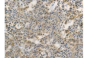ABIN6258835 and ABIN6275157 at 1/100 staining human pituitary adenoma by IHC-P. (GORASP2 Antikörper  (Internal Region))