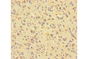 Immunohistochemistry of paraffin-embedded human glioma using ABIN7163790 at dilution of 1:100 (BMI1 Antikörper  (AA 1-247))