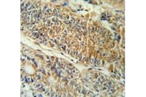 Immunohistochemistry analysis in colon carcinoma (Formalin-fixed, Paraffin-embedded) using PYCR1  Antibody (C-term), followed by peroxidase conjugation of the secondary antibody and DAB staining. (PYCR1 Antikörper  (C-Term))