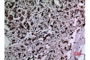 Immunohistochemical analysis of paraffin-embedded human-breast, antibody was diluted at 1:100. (HSP90 Antikörper  (acLys284, acLys292))