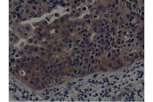 Immunohistochemical staining of paraffin-embedded Carcinoma of Human bladder tissue using anti-SH3GL1 mouse monoclonal antibody.
