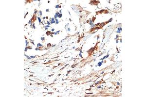 Immunohistochemistry of paraffin-embedded human lung cancer using JNK1/2/3 Rabbit pAb (ABIN7268630) at dilution of 1:100 (40x lens). (MAPK8/9/10 Antikörper)