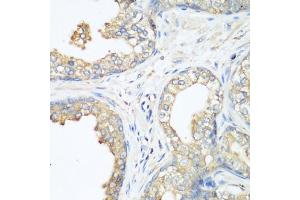 Immunohistochemistry of paraffin-embedded human prostate using CBL antibody (ABIN6131302, ABIN6138002, ABIN6138004 and ABIN6213970) at dilution of 1:200 (40x lens). (CBL Antikörper  (AA 637-906))