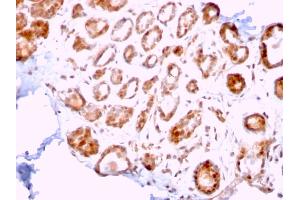 Formalin-fixed, paraffin-embedded human Breast Carcinoma stained with ERCC1 Mouse Monoclonal Antibody (ERCC1/2318). (ERCC1 Antikörper  (AA 191-281))