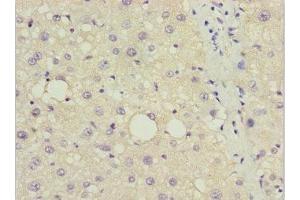 Immunohistochemistry of paraffin-embedded human liver cancer using ABIN7150132 at dilution of 1:100