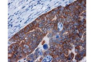 Immunohistochemical staining of paraffin-embedded Adenocarcinoma of breast tissue using anti-RALBP1 mouse monoclonal antibody. (RALBP1 Antikörper)