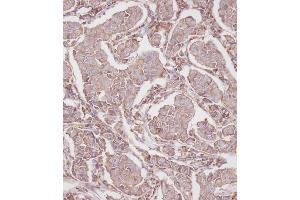 Immunohistochemical analysis of B on paraffin-embedded Human breast carcinoma tissue.