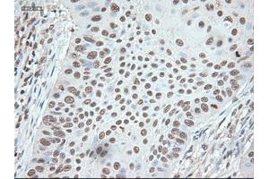 Immunohistochemical staining of paraffin-embedded Adenocarcinoma of colon using anti-Nog (ABIN2452676) mouse monoclonal antibody. (NOG Antikörper  (AA 28-232))