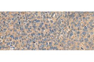Immunohistochemistry of paraffin-embedded Human cervical cancer tissue using AHNAK Polyclonal Antibody at dilution of 1:50(x200) (AHNAK Antikörper)