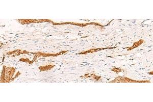 Immunohistochemistry of paraffin-embedded Human esophagus cancer tissue using THNSL1 Polyclonal Antibody at dilution of 1:70(x200) (THNSL1 Antikörper)