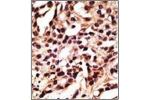 Formalin-fixed and paraffin-embedded human cancer tissue reacted with Autophagy APG12L Antibody (N-term), which was peroxidase-conjugated to the secondary antibody, followed by DAB staining. (ATG12 Antikörper  (N-Term))