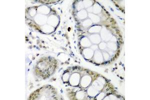Immunohistochemistry of paraffin-embedded human colon carcinoma using CDC27 antibody at dilution of 1:200 (40x lens). (CDC27 Antikörper)