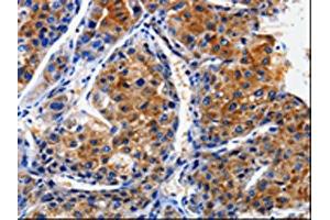 The image on the left is immunohistochemistry of paraffin-embedded Human liver cancer tissue using ABIN7128952(CLCA4 Antibody) at dilution 1/10, on the right is treated with fusion protein. (CLCA4 Antikörper)