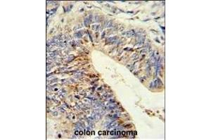 Formalin-fixed and paraffin-embedded human colon carcinoma reacted with ADDEC1 Antibody (N-term), which was peroxidase-conjugated to the secondary antibody, followed by DAB staining. (ADAMDEC1 Antikörper  (N-Term))