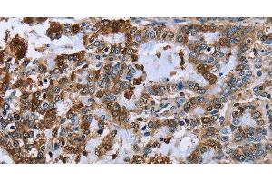 Immunohistochemistry of paraffin-embedded Human liver cancer using IMPDH2 Polyclonal Antibody at dilution of 1:60 (IMPDH2 Antikörper)