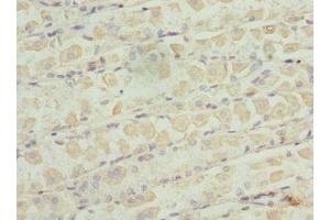 Immunohistochemistry of paraffin-embedded human gastric cancer using ABIN7176235 at dilution of 1:100 (ZNF324 Antikörper  (AA 1-270))