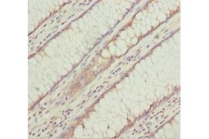 Immunohistochemistry of paraffin-embedded human colon cancer using ABIN7157310 at dilution of 1:100 (KLHL7 Antikörper  (AA 427-586))