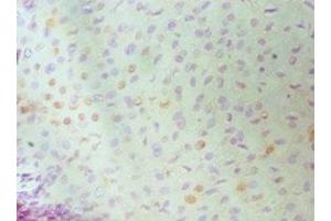 Immunohistochemistry of paraffin-embedded human cervical cancer using ABIN7150339 at dilution of 1:100