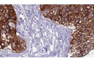 ABIN6276569 at 1/100 staining Human urothelial cancer tissue by IHC-P. (SMPD2 Antikörper  (Internal Region))