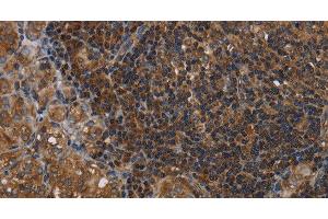 Immunohistochemistry of paraffin-embedded Human thyroid cancer tissue using HOMER2 Polyclonal Antibody at dilution 1:40 (HOMER2 Antikörper)