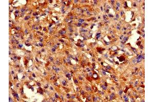 IHC image of ABIN7155391 diluted at 1:800 and staining in paraffin-embedded human melanoma performed on a Leica BondTM system. (HIST1H2BB Antikörper  (AA 2-126))