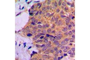 Immunohistochemical analysis of RPL7 staining in human prostate cancer formalin fixed paraffin embedded tissue section.