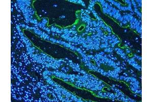 IF analysis of Villi using anti-Villi antibody (ABIN3042343) Villi was detected in paraffin-embedded section of human rectal cancer tissues. (Villin 1 Antikörper  (C-Term))