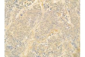 ABIN6262538 and ABIN6278893 at 1/100 staining human small cell lung carcinoma by IHC-P. (IL17B Antikörper  (Internal Region))