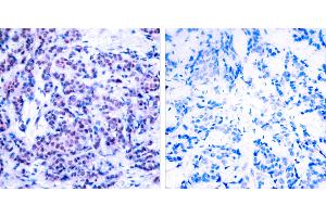 P-Peptide - +Immunohistochemical analysis of paraffin-embedded human breast carcinoma tissue using JunD (phospho- Ser255) antibody. (JunD Antikörper  (pSer255))