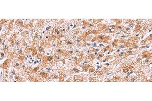 Immunohistochemistry of paraffin-embedded Human liver cancer tissue using IL4R Polyclonal Antibody at dilution of 1:45(x200) (IL4 Receptor Antikörper)