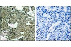 Immunohistochemistry analysis of paraffin-embedded human breast carcinoma, using MEK1/2 (Phospho-Ser221) Antibody. (MEK1/2 Antikörper  (pSer222))