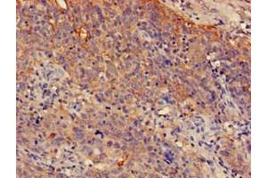 Immunohistochemistry of paraffin-embedded human cervical cancer using ABIN7148581 at dilution of 1:100 (SPRR1A Antikörper  (AA 8-72))