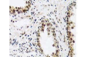 Immunohistochemistry of paraffin-embedded Human prostate using SAFB2 Polyclonal Antibody at dilution of 1:100 (40x lens). (SAFB2 Antikörper)