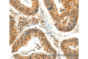 Immunohistochemistry of Human colon cancer using TERF2 Polyclonal Antibody at dilution of 1:50 (TRF2 Antikörper)