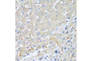 Immunohistochemistry of paraffin-embedded human liver cancer using PPBP antibody (ABIN5970990) at dilution of 1/100 (40x lens). (CXCL7 Antikörper)
