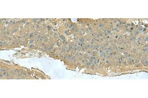 Immunohistochemistry of paraffin-embedded Human liver cancer tissue using KRT36 Polyclonal Antibody at dilution of 1:50(x200) (Keratin 36 Antikörper)