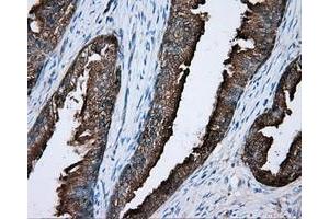 Immunohistochemical staining of paraffin-embedded Carcinoma of liver tissue using anti-PRKAR2A mouse monoclonal antibody. (PRKAR2A Antikörper)