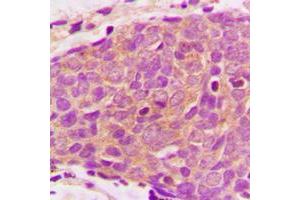Immunohistochemical analysis of PRAS40 staining in human breast cancer formalin fixed paraffin embedded tissue section. (PRAS40 Antikörper  (C-Term))
