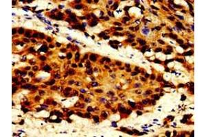 Immunohistochemistry of paraffin-embedded human cervical cancer using ABIN7150346 at dilution of 1:100 (TOP2B Antikörper  (AA 1400-1626))