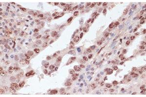 Immunohistochemistry of paraffin-embedded Human lung cancer using Phospho-ATF2(T71) Polyclonal Antibody at dilution of 1:100 (40x lens). (ATF2 Antikörper  (pThr71))